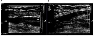 Evaluation of Lower Limb Arteriovenous Diameters in Indoor Soccer Athletes: Arterial Doppler Ultrasound Study